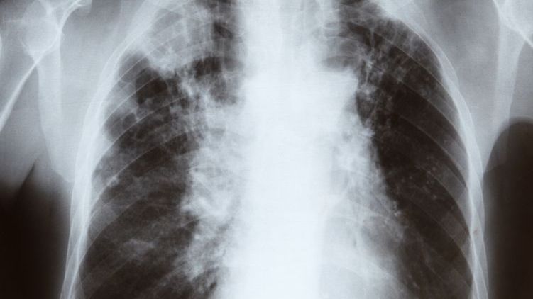 POChP to przewleła choroba. Trzecia przyczyna zgonów.