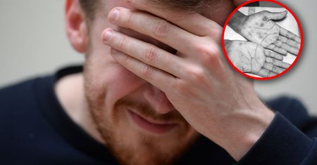 Wstydliwy problem, zachorowań przybywa. "Można mówić o renesansie kiły"