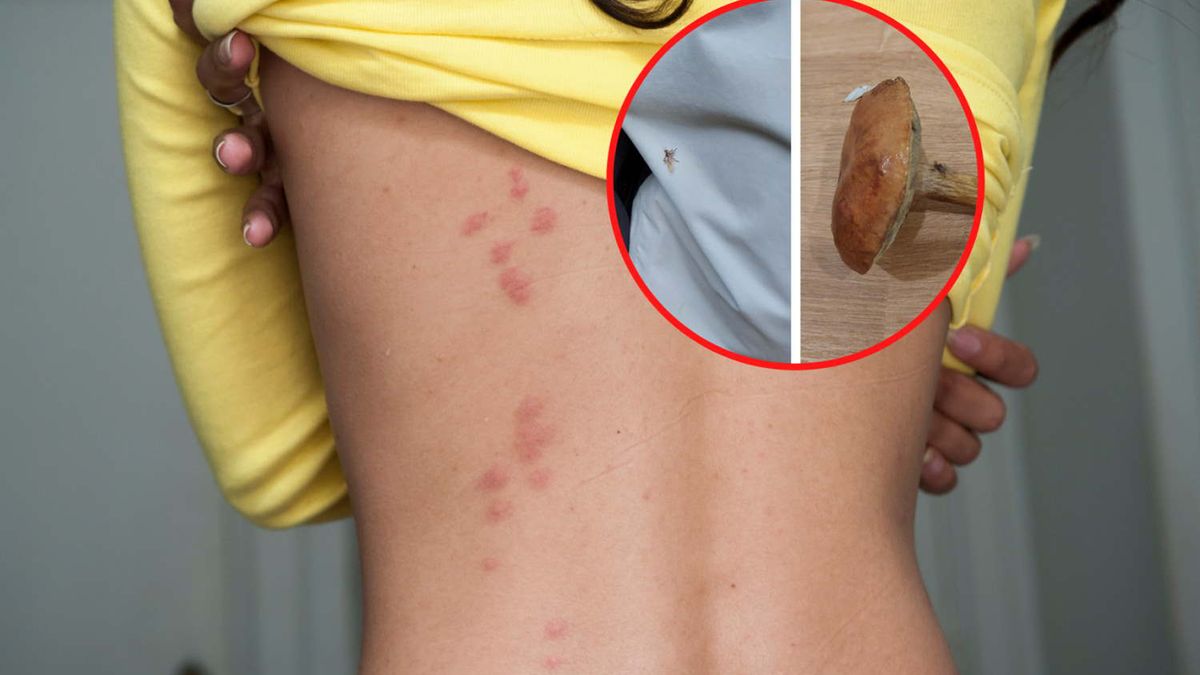 Uważaj na nie w lesie, zostawiają bolesny ślad na skórze