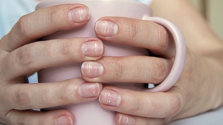 Many white spots on fingernails (Leukonychia) due to calcium deficit or stress. Female hands holding mugMany white spots on fingernails (Leukonychia) due to calcium deficit or stress. Female hands holding mugNadya Sohands only, white spot, discoloration, beriberi, leukonychia, calcium deficiency, punctate, ferrum, without manicure, leuconychia, sick nails
