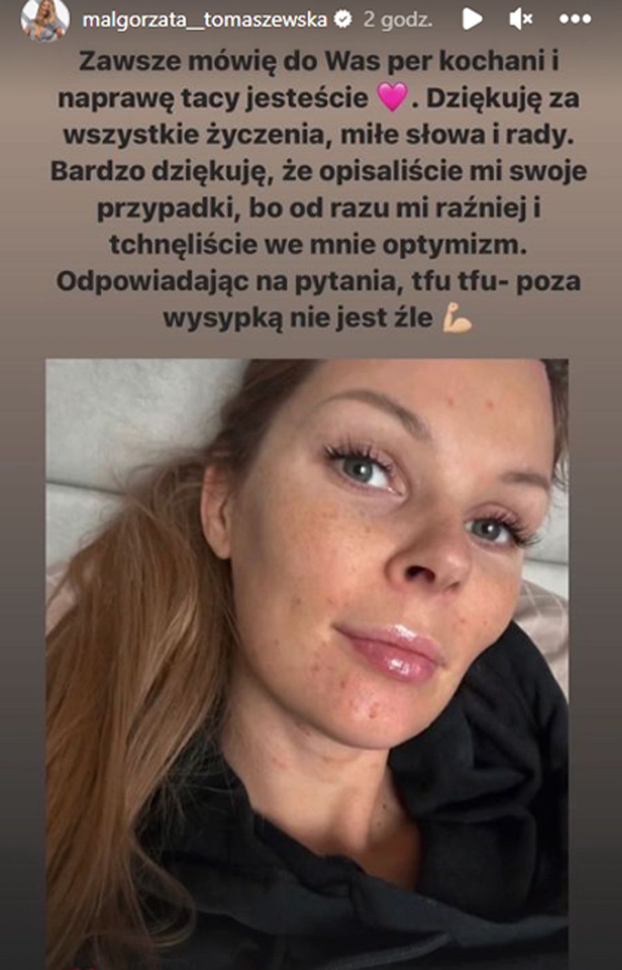 Małgorzata Tomaszewska choruje na ospę wietrzną