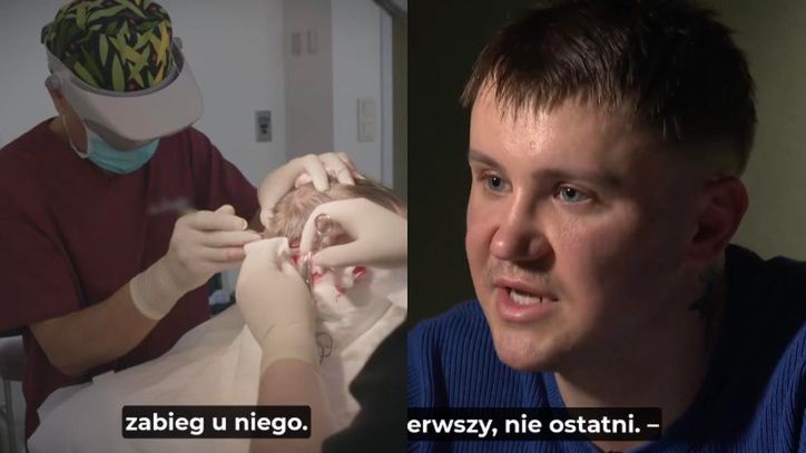 Poddali się przeszczepowi włosów w polecanej klinice