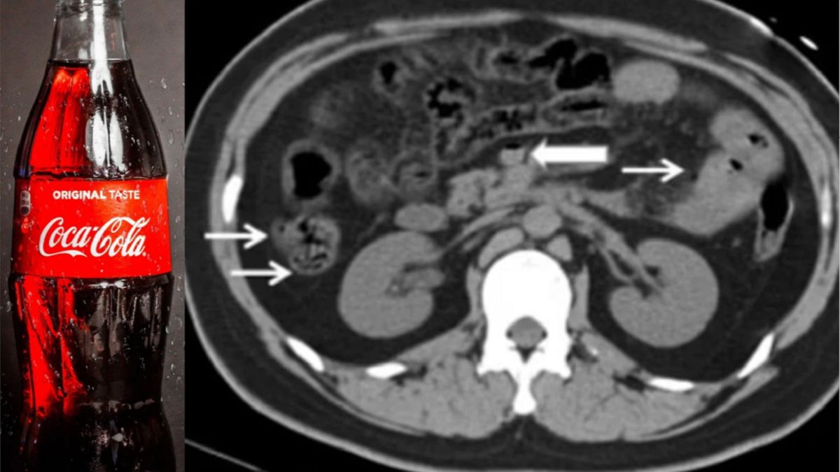 Tragedia w Chinach. 22-latek zmarł po wypiciu 1,5 coli