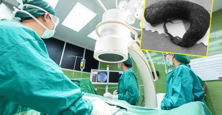 Trichobezoar w brzuchu kobiety. Lekarze złapali się za głowy