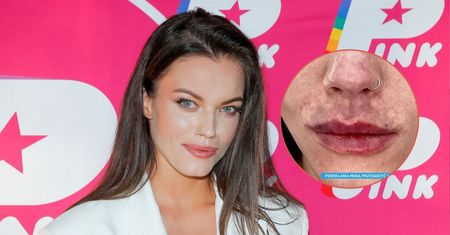 To spotkało gwiazdę "Top Model" po powiększeniu ust. "Dopiero niedawno doszłam do siebie"