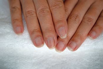 Masz czarną kreskę na paznokciu? Nie lekceważ. To ważny sygnał