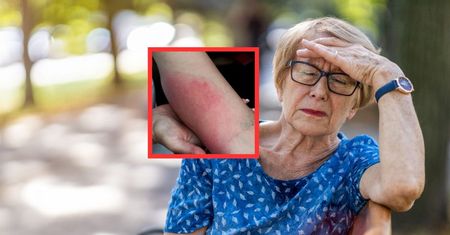 Znaczący wzrost zakażeń w Polsce. Objawy to zmęczenie, zmiana skórna