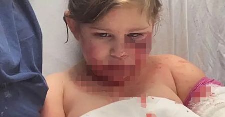 "Nie będzie mogła się uśmiechać". 3-latka pogryziona przez psa