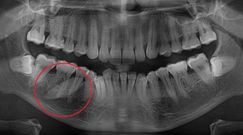 Olbrzymi kamień w szczęce. Dentysta nie wierzył własnym oczom