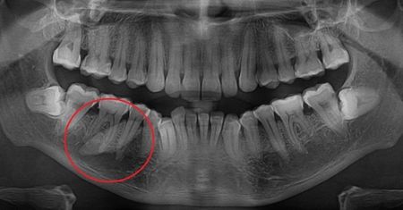 Olbrzymi kamień w szczęce. Dentysta nie wierzył własnym oczom