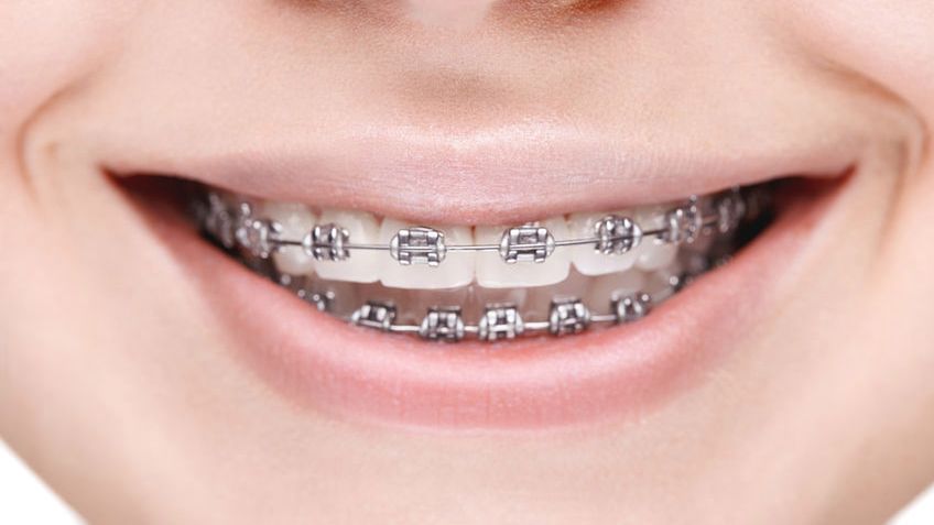 Gumki separacyjne to rodzaj gumek, które wprowadza się pomiędzy zęby boczne w celu ich rozsunięcia.