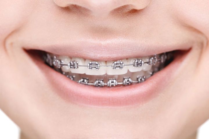 Gumki separacyjne to rodzaj gumek, które wprowadza się pomiędzy zęby boczne w celu ich rozsunięcia.