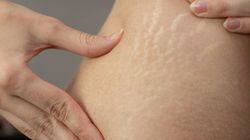 Rozstępy zaczynają się od środka. Co jeść, żeby skóra nie pękała?