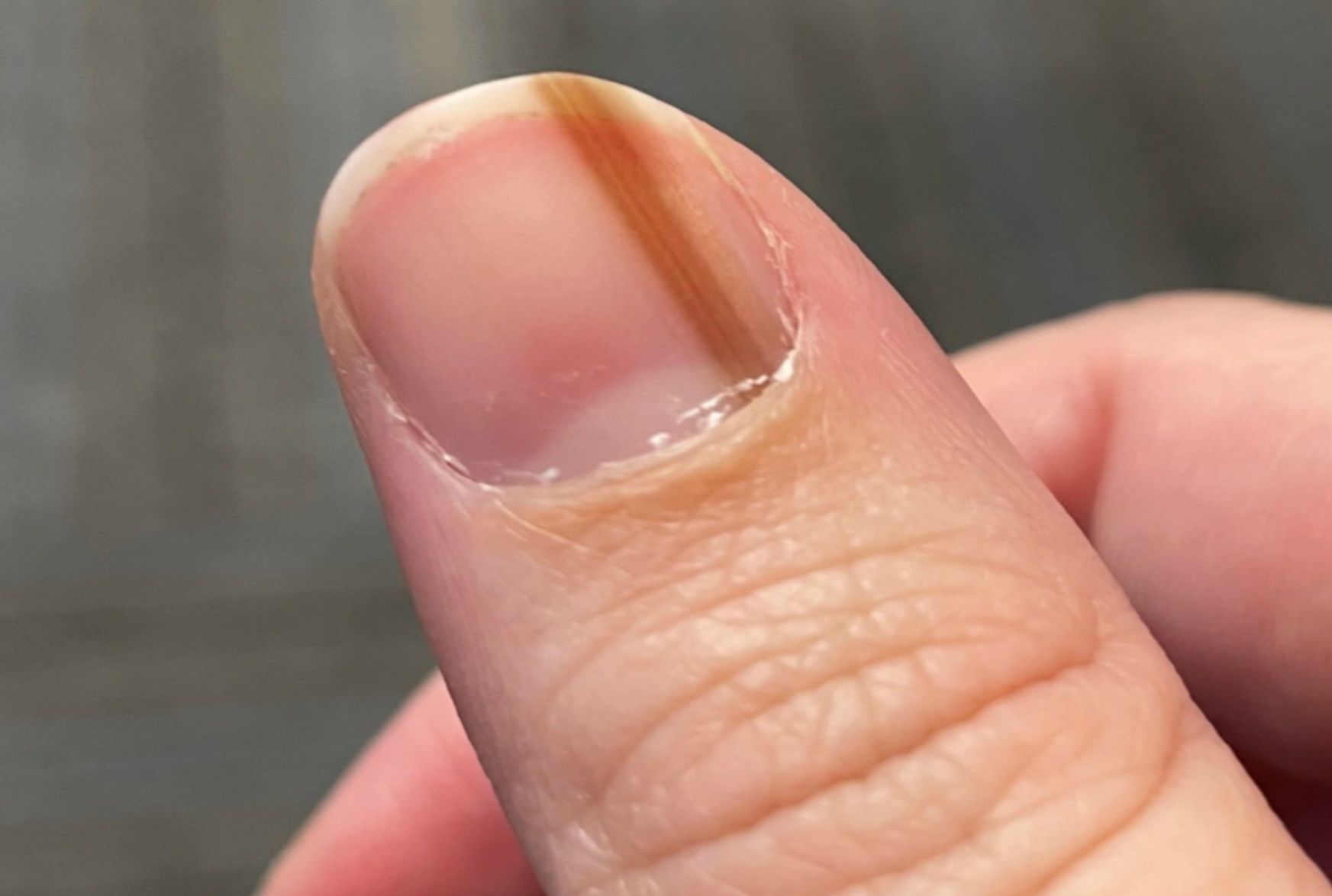 Maria Sylvia myślała, że to był krwiak. 