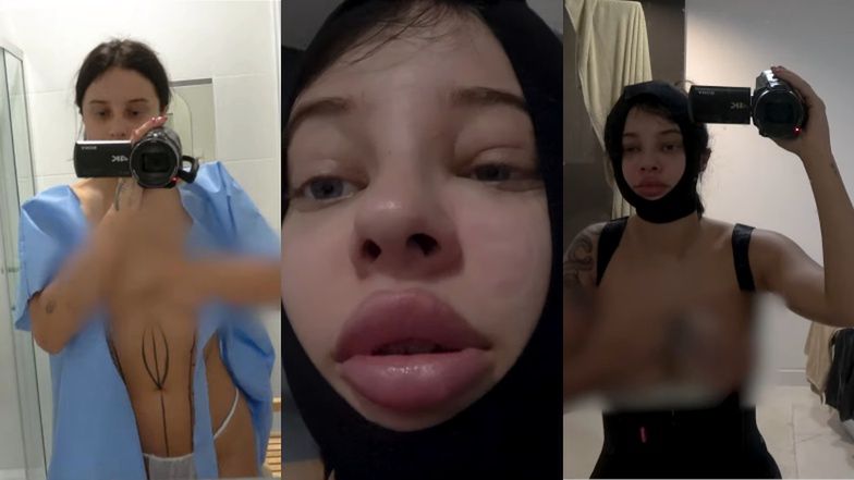 Fagata poddała się drugiemu zabiegowi BBL