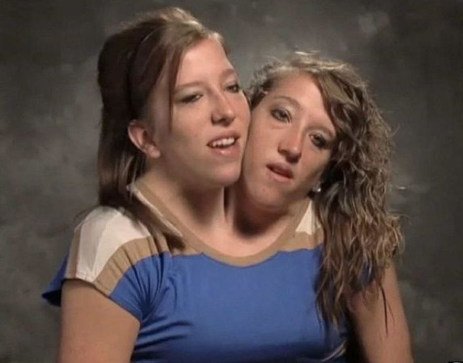 Abby i Brittany Hensel 