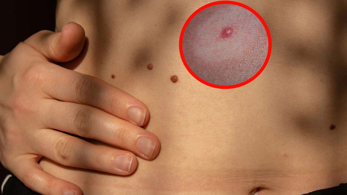 Znamię Suttona to zmiana melanocytarna otoczona odbarwioną otoczką