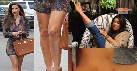 Kim Kardashian opóźnia powrót do show biznesu, bo ma... łuszczycę na twarzy!