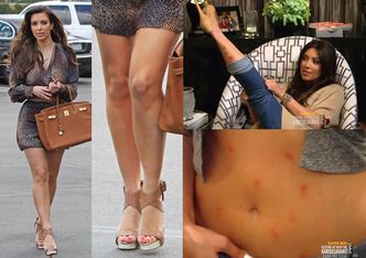 Kim Kardashian opóźnia powrót do show biznesu, bo ma... łuszczycę na twarzy!