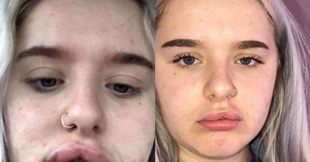 17-latka wstrzyknęła w usta wypełniacz. "Nienawidziłam swojej twarzy"