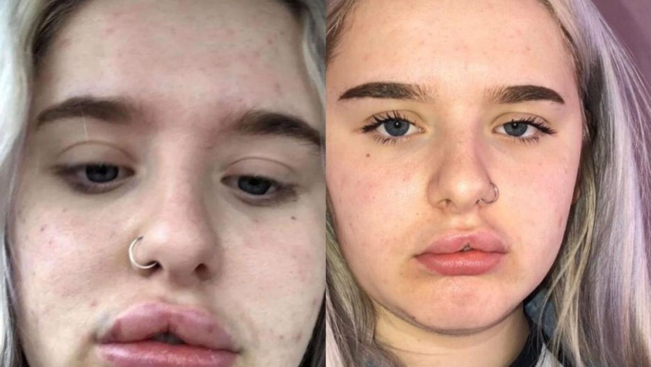 17-latka wstrzyknęła w usta wypełniacz. "Nienawidziłam swojej twarzy"