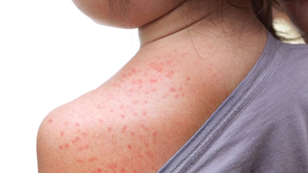 Trzydniówka u dzieci