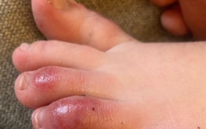 Covidowe palce mogą być jednym z nietypowych objawów zakażenia koronawirusem
