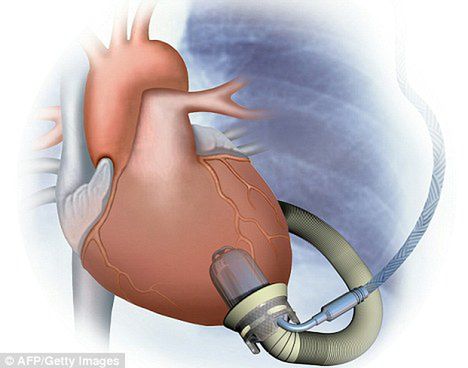 Pierwsze sztuczne serce zamontowane na stałe w organizmie dziecka