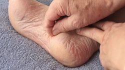 Drożdżyca - przyczyny, objawy, zapobieganie, leczenie