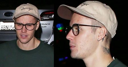 Bieber ma poważne problemy z cerą. Trądzik czy niezdrowy tryb życia? (FOTO)