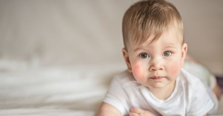 Skaza białkowa u noworodka - przyczyny i objawy, leczenie