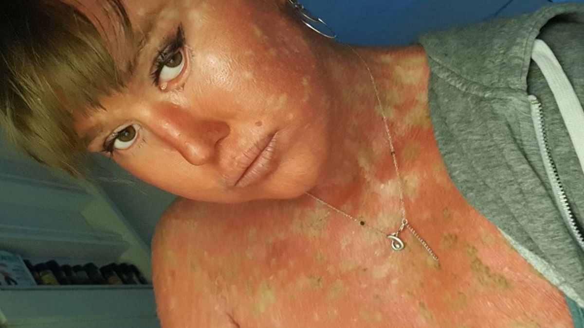 Nathalie Richert cierpi na rzadką chorobę, która sprawia, że jej skóra jest czerwona