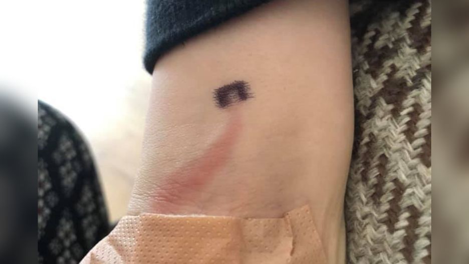 Czerwona pręga na ramieniu była objawem sepsy. Mama zareagowała błyskawicznie