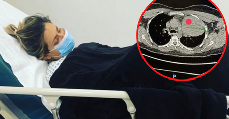 Nie rozpoznali rzadkiego nowotworu, dopóki nie pojawiły się przerzuty. Jeden z guzów ma rozmiar mandarynki
