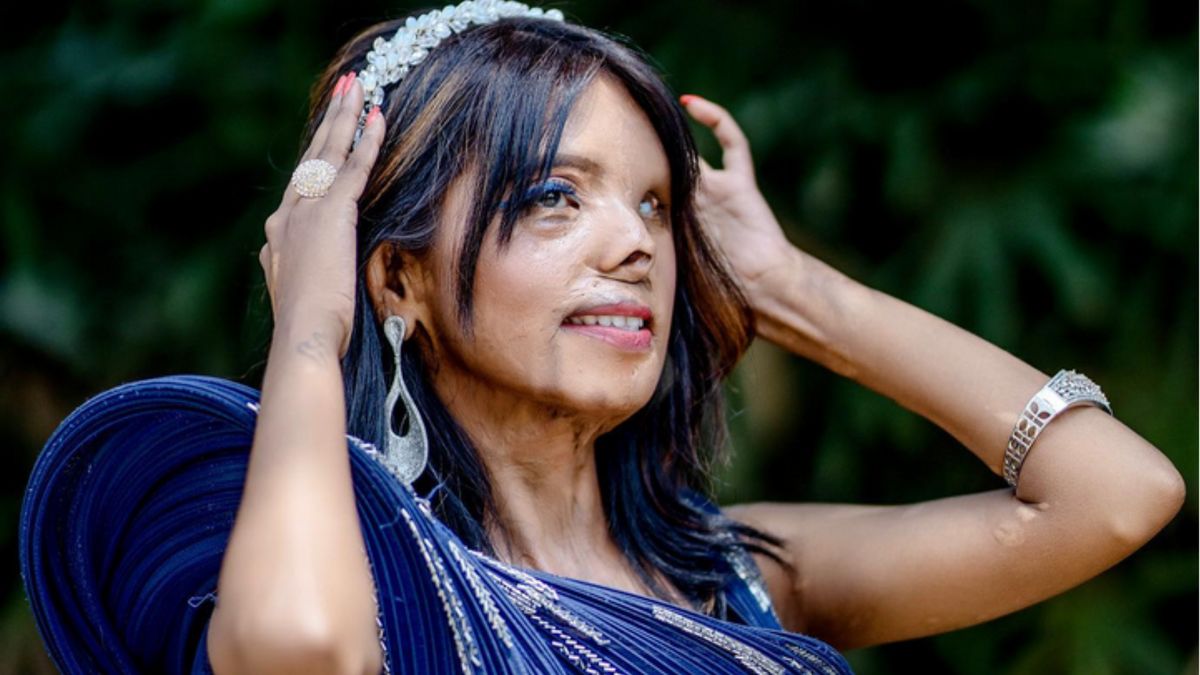 Anamol została oblana kwasem przez ojca