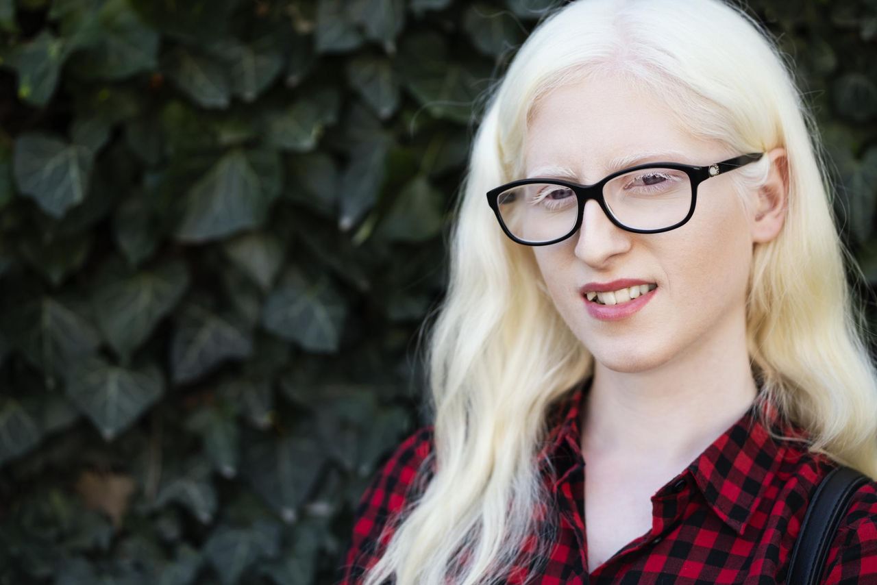 Ich życie warte jest 75 tys. dolarów. Albinosi każdego dnia walczą o życie