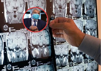 Zbadali mózgi osób po udarze. Ustalili, co do niego doprowadziło