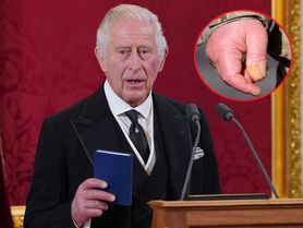 Karol III ma "kiełbasiane" palce. Brytyjczycy boją się o króla, lekarz zabiera głos
