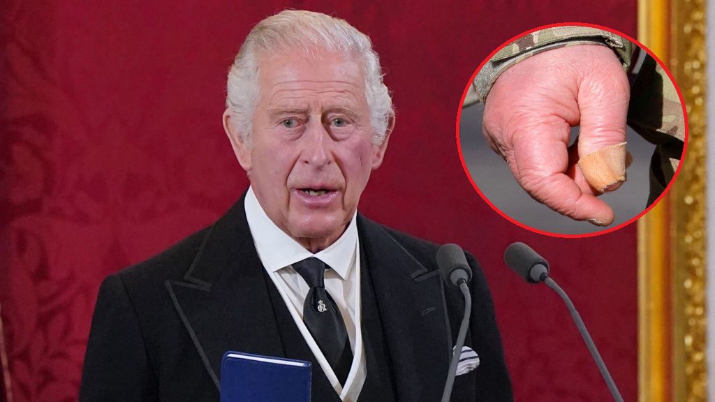 Opuchnięte palce mogą świadczyć o chorobie