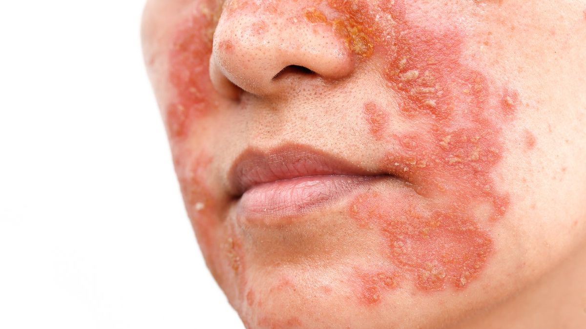 Łojotokowe zapalenie skóry to przewlekła, nawracająca choroba. Cechuje się łuszczącą skórą na twarzy, we włosach i innych miejscach ciała.