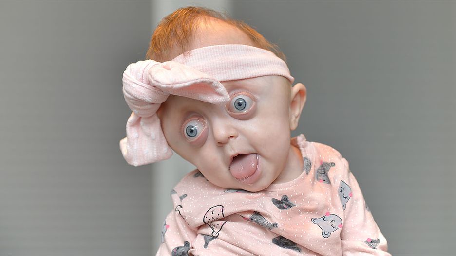 Hania cierpi na rzadką chorobę genetyczną. "Ludzie komentowali, że co z nas za rodzice, przecież mogliśmy usunąć takie dziecko"