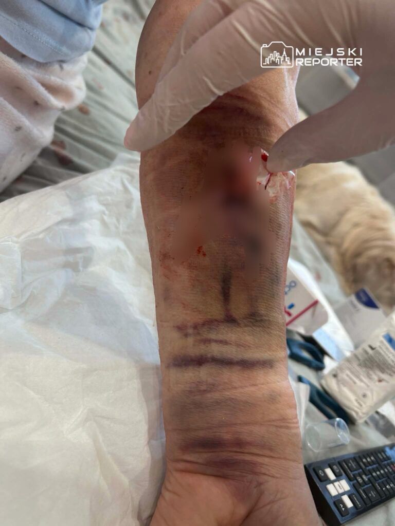 Ręka z widocznymi obrażeniami i siniakami, na której osoba w rękawiczkach zakłada opatrunek. W tle materiały medyczne.