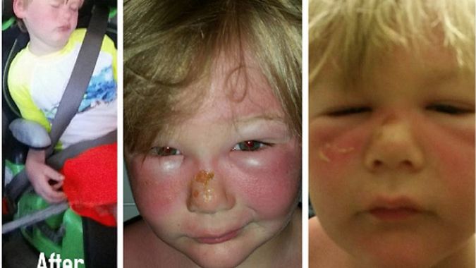 Chłopiec poparzony przez słońce. Winny przeterminowany filtr?