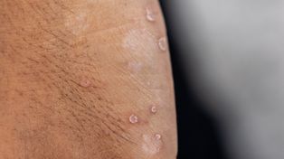 Naukowcy powiązali toczeń z wirusem. Jego nosicielem jest prawie każdy