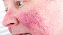 Tak wygląda alkoholowa twarz. Zmiany widoczne gołym okiem