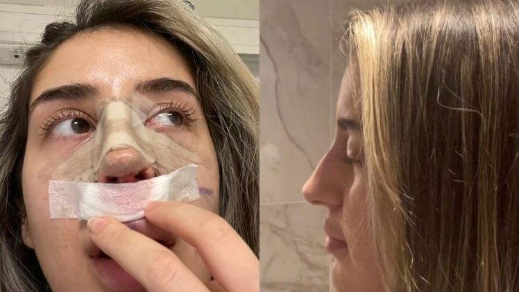 Tiktokerka poleciała do Turcji zoperować sobie nos