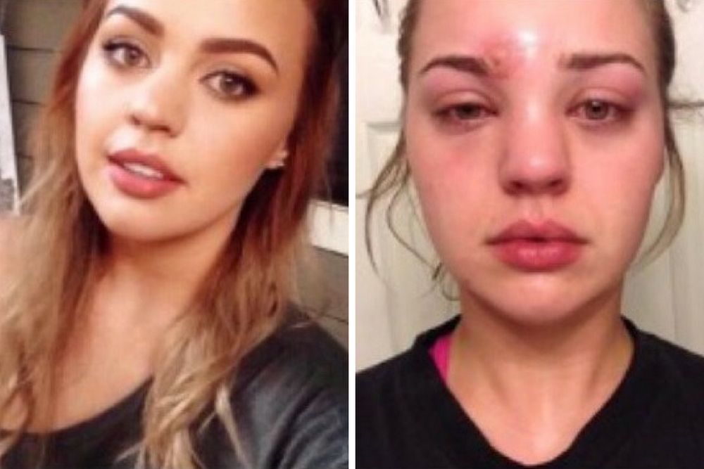 U Katie lekarze stwierdzili cellulitis