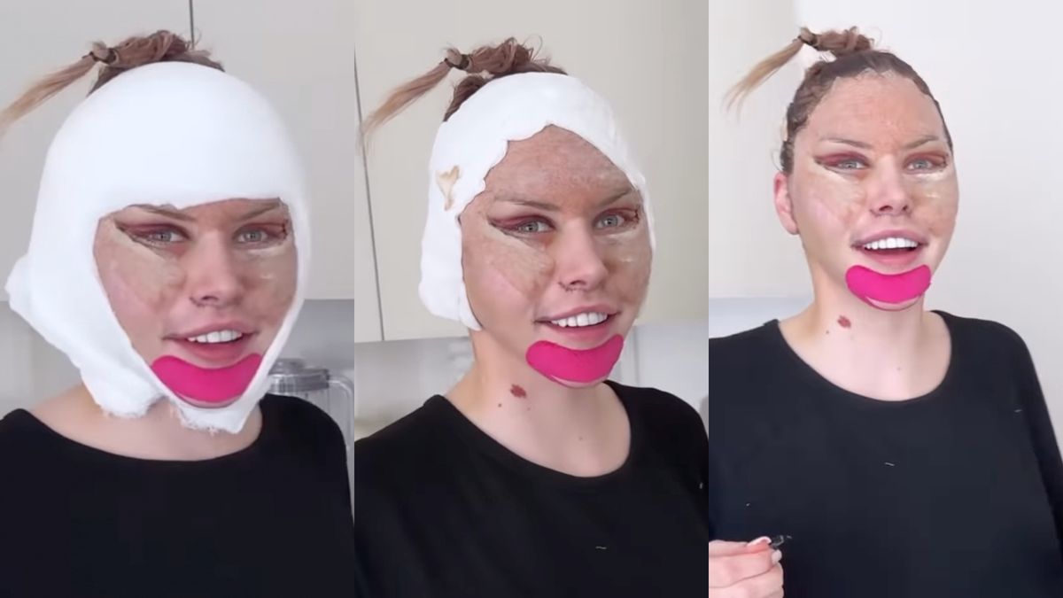 Julia von Stein zdjęła opatrunek po liftingu twarzy