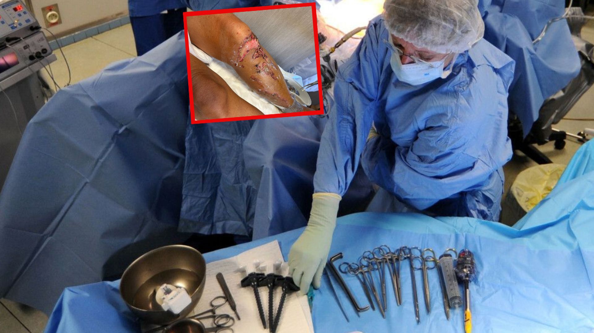 Złamana kość noga pani Haliny został nastawiona, ale ze szpitala kobieta wyszła poparzona