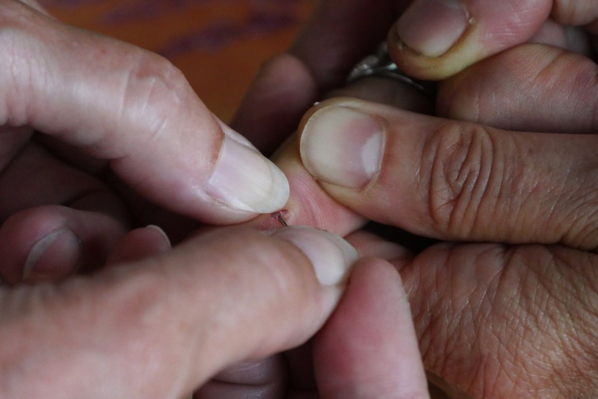 Wystarczy niewielkie skaleczenie. Może się skończyć nawet sepsą